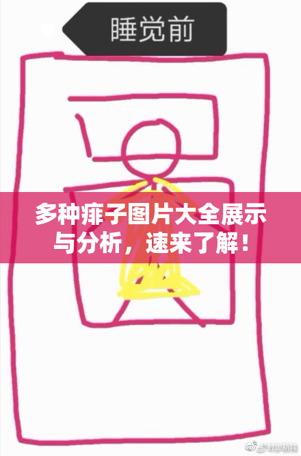 多种痱子图片大全展示与分析，速来了解！
